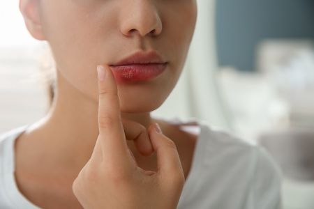 Opryszczka – skąd się bierze i jak ją skutecznie zwalczać?